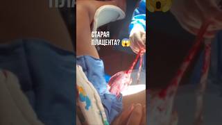 Старая плацента ? #shorts #беременность #роды #родыдома #домашниероды