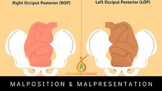 Malposition.||Occipito Posterior Position || Hindi Explanation @Ritikas Nursing Tutorials