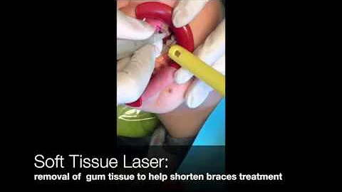 Laser treatment to help your braces