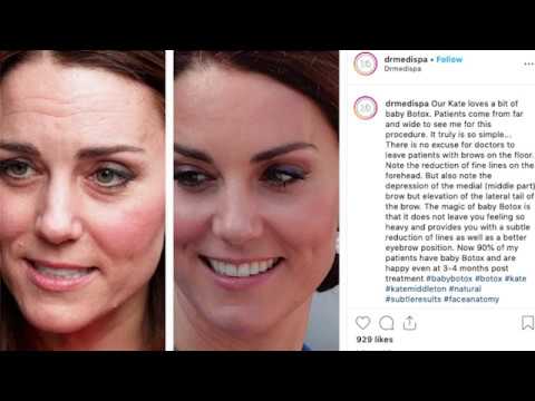 Videó: Kate Middleton és Botox