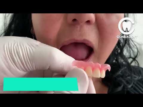 Video: Cómo hacer frente a las dentaduras postizas parciales: 11 pasos (con imágenes)