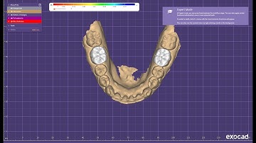 Onlay designing for lower molars in exocad