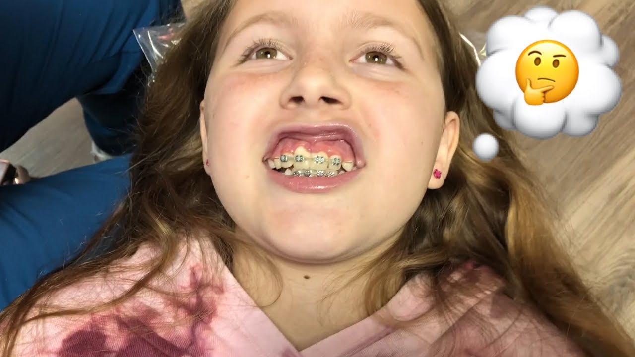 10th Braces Visit Unexpected Swollen Gums Youtube