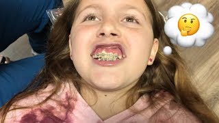 10th Braces Visit || Unexpected: Swollen Gums