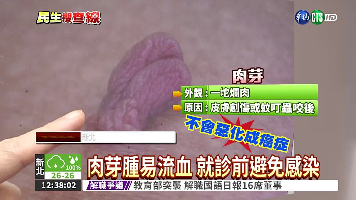 皮肤长"红点" 小心恶性血管痣 - 天天要闻