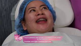 FACE SLIMMING AND DOUBLE CHIN REDUCTION USING  ULTRAFORMER III