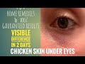 Chicken Skin Under Eyes | Natural Home Remedies with 100% results.