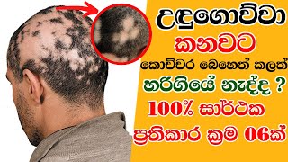 Alopecia Areata Treatment | Udugowwa Kemata Beheth | උඳුගොව්වන් කෑමට 100% සාර්ථක ප්‍රතිකාරක්‍රම 06ක්