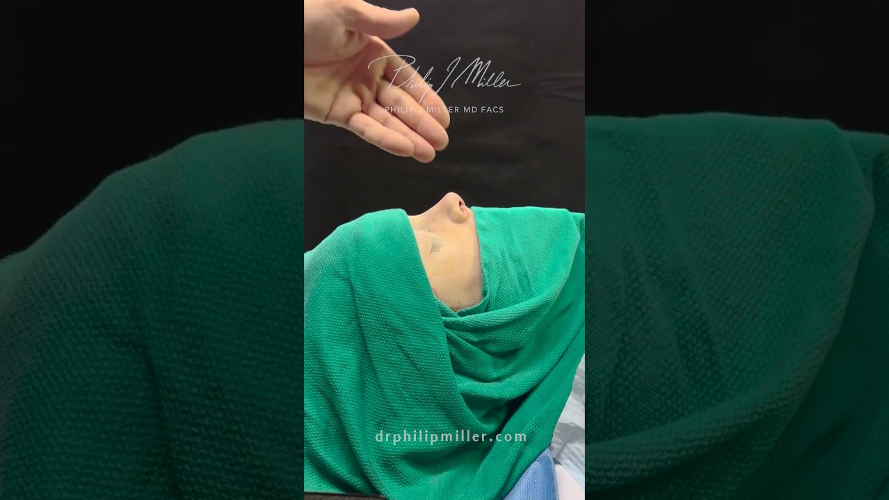 Immediate rhinoplasty results!