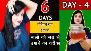 गंजेपन का इलाज | बालो को झड़ने से रोकने के उपाय | 6 DAYS HAIR Regrowth Naturally Baldness Treatment