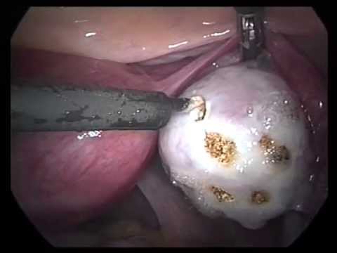 Laparoscopic Videos Miscl (edited-2)- PCO Drilling