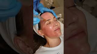 Microneedling treatment for Jane ?