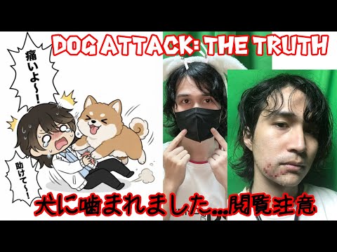 【閲覧注意】ずっと黒マスクを着けて配信していた理由（実は犬に顔を噛まれました） Why I Was Wearing a Mask: Dog Attack Story