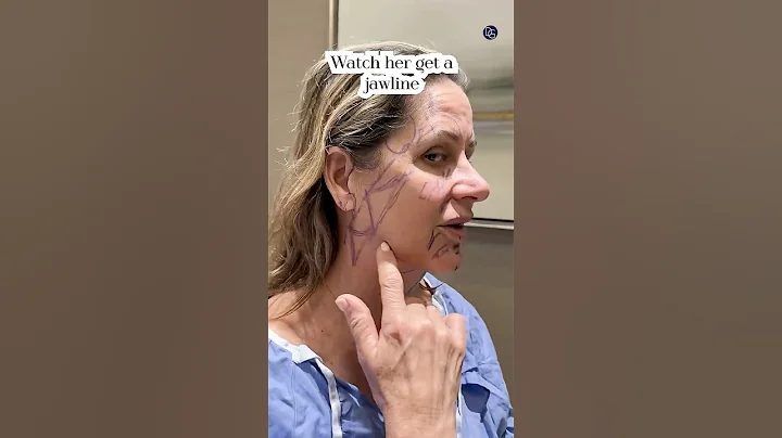 Natural Results| Face and Neck Lift 2 Months Post-Op| Before and After