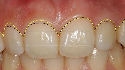 Gingivectomy guide with digital workflow: Cerec & Varseo XS
