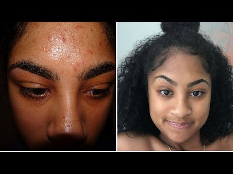 HOW I STOPPED USING FACE WASH TO CLEAR MY SKIN!!