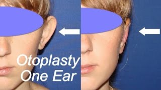 Otoplasty One Ear // Operation // Dr. Duzhy // Односторонняя отопластика // Дужий Алексей(Operation was performed on patient with assimetrial ears. Operation was made by Aliaksei Duzhy, M. D. I made just one ear. The patient was sutisfacted with ..., 2016-06-30T09:07:04.000Z)