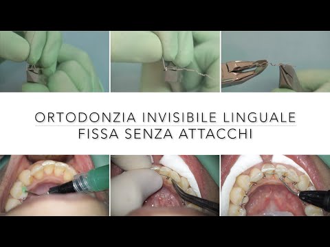 Video: Gli apparecchi linguali sono più dolorosi?