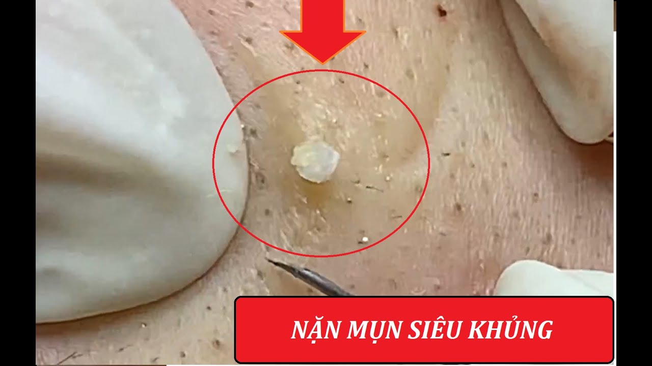 Giant blackheads & Severe cystic acne squeezed (4) | Loan Nguyen