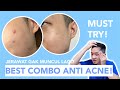 Cuma 3 step! Best combo anti acne skincare nya Garnier... Jerawat gak balik lagi?