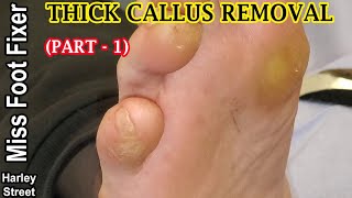 Satisfying thick callus removal from Toe By Miss Foot Fixer Marion Yau