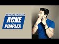 How to get rid of ACNE & PIMPLES (Naturally) | Info by Guru Mann