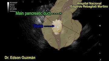 Pancreatolitihasis in EUS : Gastric and duodenal bulb stations