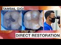 Replacing Amalgam to Natural Composite Bonding Restoration | General Dentist Griya RR