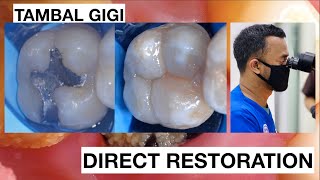 Replacing Amalgam to Natural Composite Bonding Restoration | General Dentist Griya RR