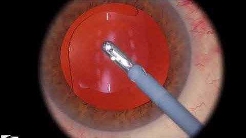 EyeSi CAT C IOL Insertion, Level 2 (toric IOL inserted, remove viscoelastic)