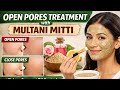 Open Pores Treatment At Home With Multani Mitti Pores Closing Remedy 