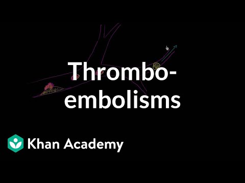 Thromboemboli and thromboembolisms | Miscellaneous | Heatlh & Medicine | Khan Academy