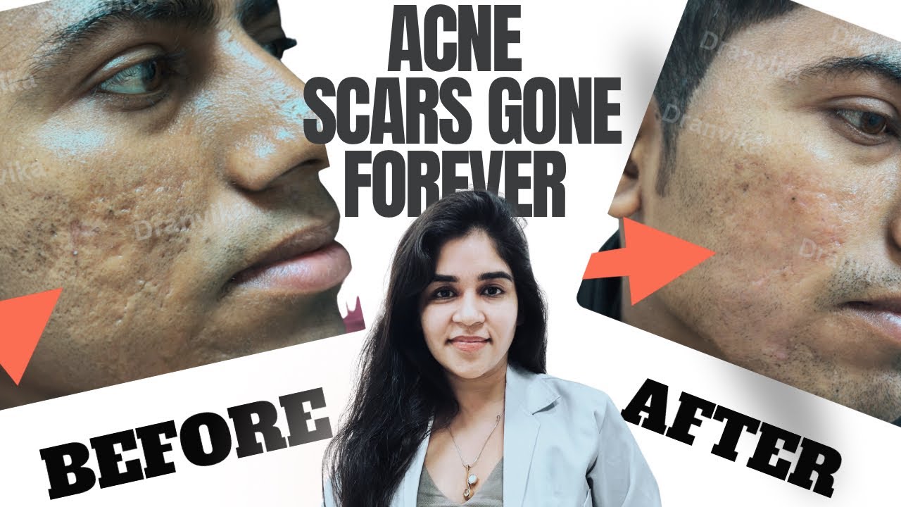 Acne Scars treatment | laser for acne scars | पिंपल्स के स्कार का इलाज 