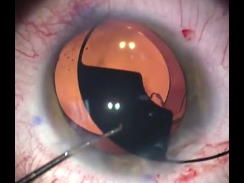 Iris coloboma:  laser cataract surgery + artificial iris (Morcher) & toric IOL - Dr Simon Chen HD