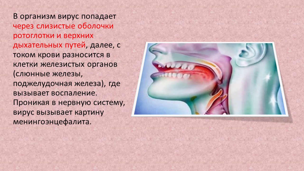 Эпидемический паротит