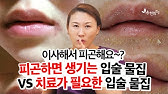 구각염의 원인/치료/예방 L 입가가 찢어졌어요 L 닥터딩요 - Youtube