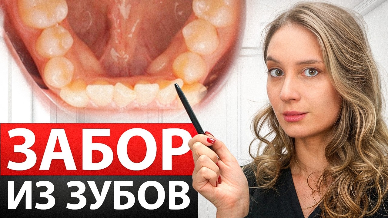 Исправление прикуса на примере наших кейсов. Скученность, протезирование зубов.