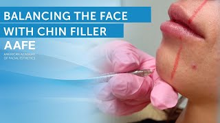 Chin Filler Changes Your Face! Treatment + Before and After