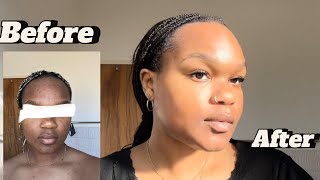 SKINCARE ROUTINE / POST ORATANE/ ACCUTANE