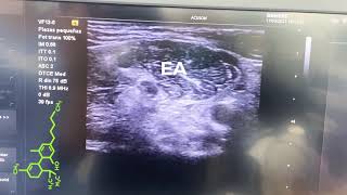 BLOQUEO DEL PLEXO CERVICAL SUPERFICIAL CON ULTRASONIDO