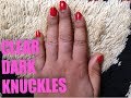 Tips On How To Get Clear Knuckles/Maintained | Clear Dark Knuckles Fast