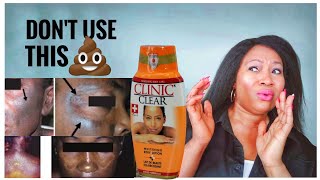 SHOCKING TRUTH ABOUT CLINIC CLEAR  | SIDE EFFECTS OF SKIN BLEACHING