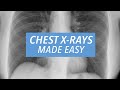Chest xrays made easy learn to read a cxr in 10 minutes