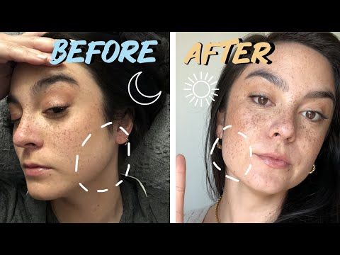 VLOG: TMJ, Botox, & Invisalign