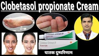 Clobetasol Cream ip tenovate | Clobetasol propionate cream