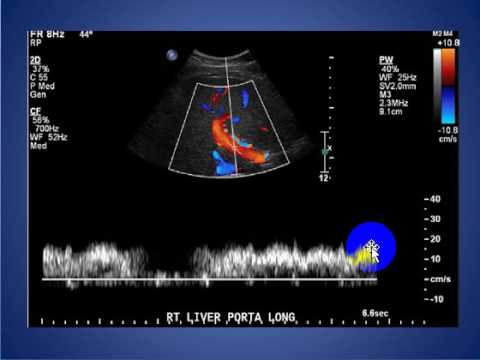 radiology cases 004 normal portal vein Doppler ultrasound