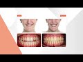 Tratamiento de ortodoncia con brackets y cirugía ortognática | Lorente Ortodoncia
