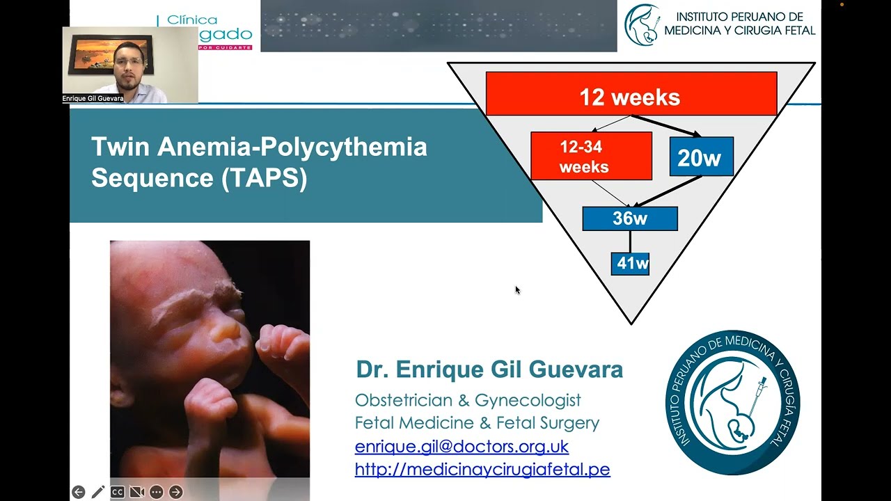 Twin Anemia Polycythemia Sequence YouTube