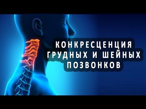 Что такое конкресценция грудных и шейных позвонков?