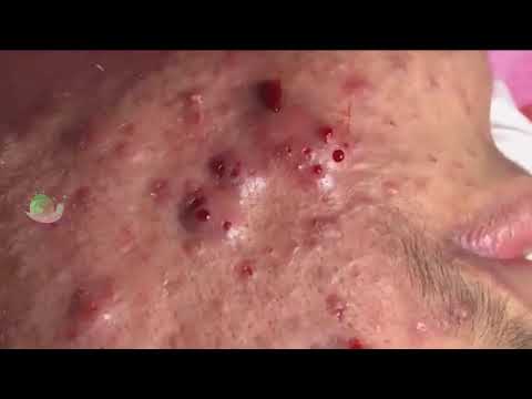 HUGE CYSTIC ACNE EXTRACTION COMPILATION !